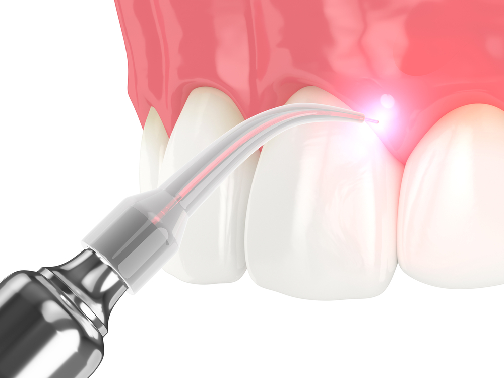 Laser Periodontal Treatment