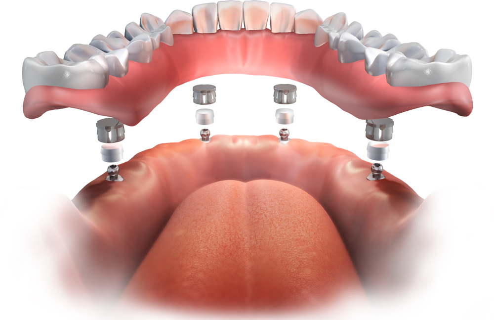 dentures laguna niguel ca