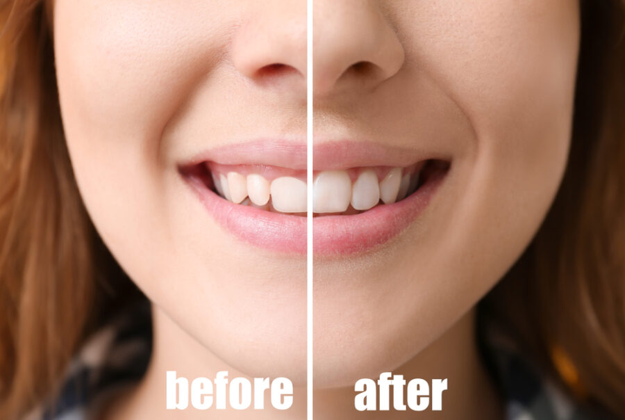 Laser Periodontal Treatment