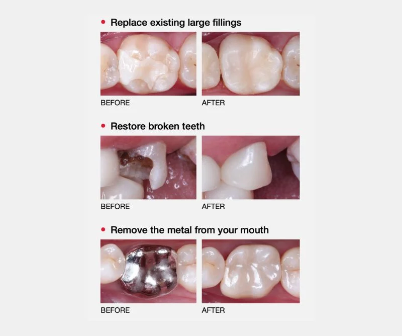 dentist in laguna niguel ca, same day crowns laguna niguels ca