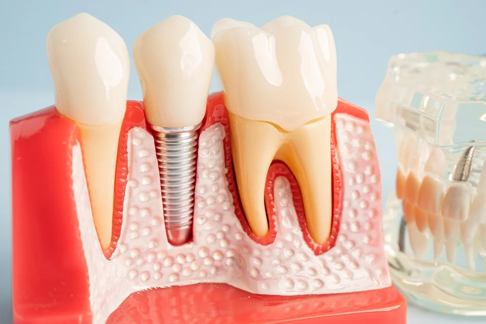 Guide to the Dental Implant Procedure in Laguna Niguel CA
