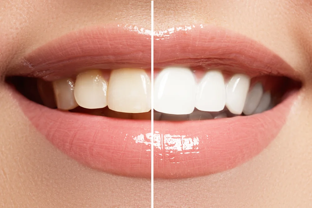 The Science Behind Teeth Bleach: Safety and Effectiveness