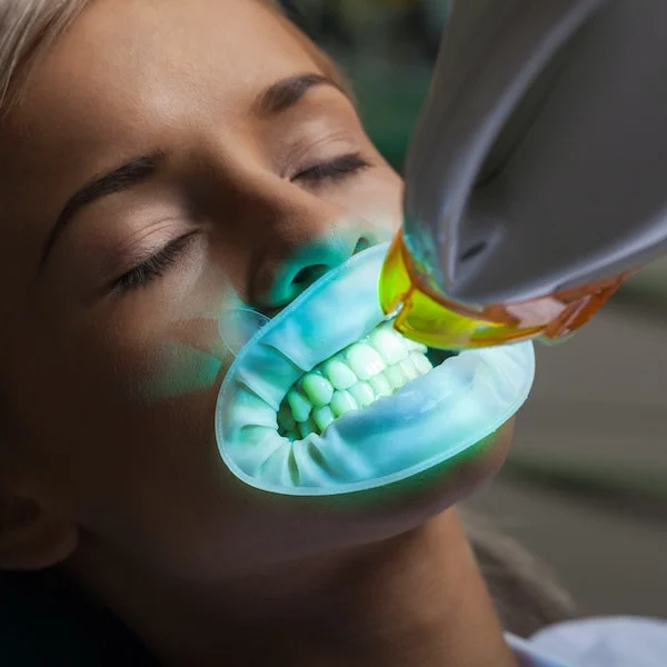Tips for Maintaining Whitened Teeth in Laguna Niguel