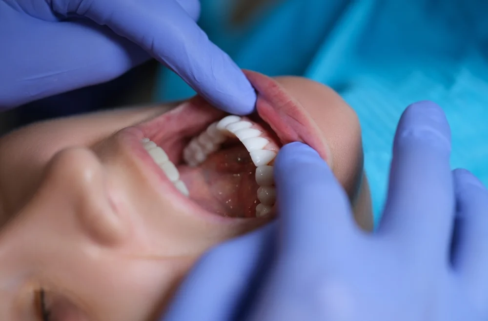 Veneers Dental Explained: Types, Benefits, and Costs