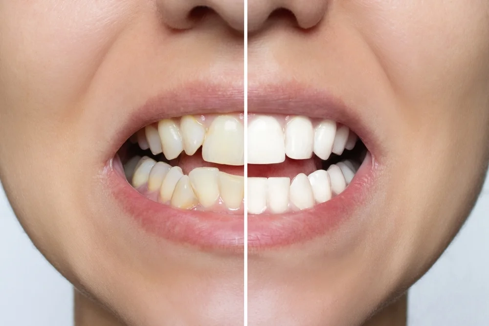 Replacing Veneers: When and Why You Should Consider It