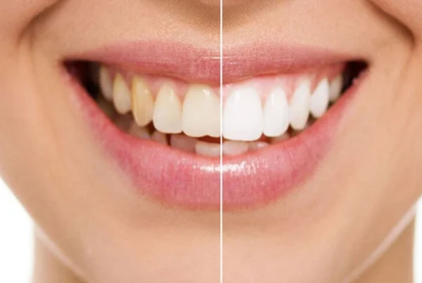 Whitening Strips: How They Work and Their Benefits