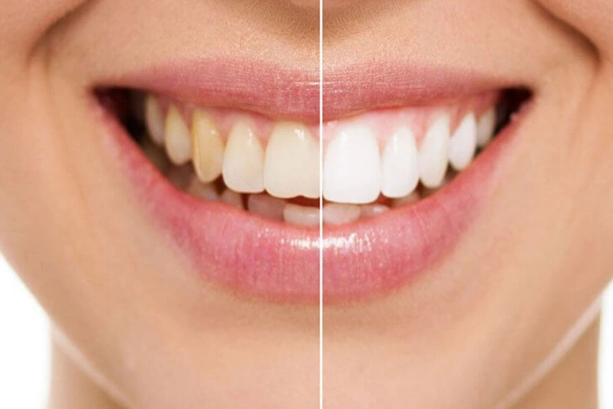 Whitening Strips: How They Work and Their Benefits