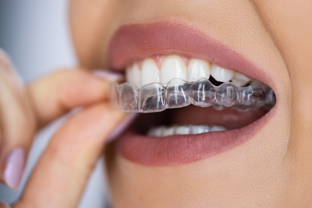 Discover the Surprising Truth About Invisalign Cost: Is It Worth It?
